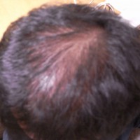 育毛治療前の僕の頭皮スケスケ頭